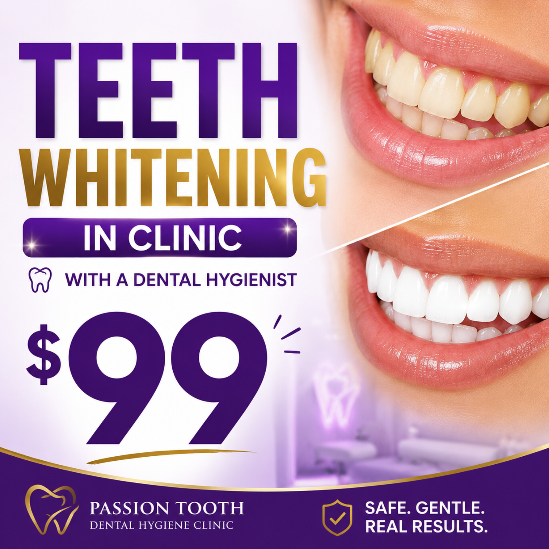 Professional Teeth Whitening + Take Home Whitening Pen